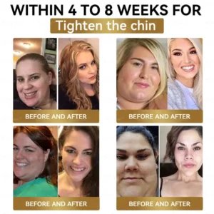 𝐁𝐮𝐢𝐥𝐝𝐋𝐞𝐚𝐟® 𝐆𝐋𝐏-𝟏 Slimming & health NANO MICRONEEDLE PATCH