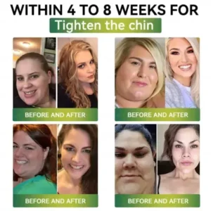 Buildleaf® SMGT-GLP-1 Nano Microneedle Patch with Collagen Peptides &Matrixyl 3000