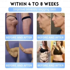 🏥FDA Store |𝐵uil𝗱𝐿ea𝐟® 𝑮𝐋𝑃-1 Slim & Firm 𝑁ano 𝑀icroneedle 𝑃atch with Collagen,Turmeric&Matrixyl 3000 丨Obesity,Cardiovascular Diseas, Diabetes, Sleep Apnea, Joint Problems and More