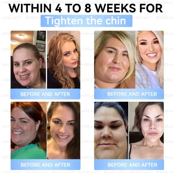 ✔️FDA Store |𝐵uil𝗱𝐿ea𝐟® 𝑮𝐋𝑃-1 Slim & Firm 𝑁ano 𝑀icroneedle 𝑃atch with Collagen,Turmeric&Matrixyl 3000 丨Obesity,Cardiovascular Diseas, Diabetes, Sleep Apnea, Joint Problems and More (Copy)