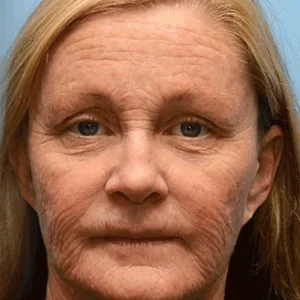 Flysmus® Botox Jellyfish Venom Peptide Nanoliposome Sculpting Anti-Wrinkle Cream