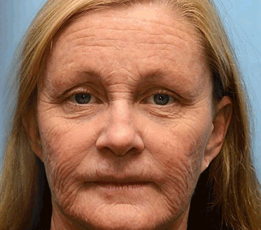 Flysmus® Botox Jellyfish Venom Peptide Nanoliposome Sculpting Anti-Wrinkle Cream