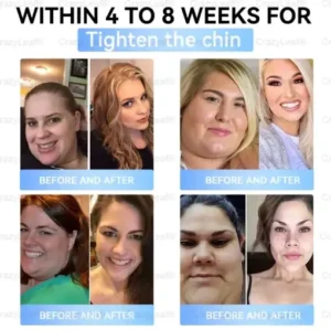 𝐵uil𝗱𝐿ea𝐟® 𝑺𝑀𝗚T-𝑮𝐋𝑃-1 𝐒limming & 𝐻ealth 𝑁ano 𝑀icroneedle 𝑃atch