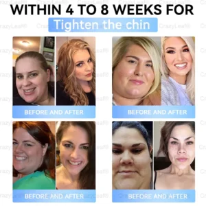 𝐵uil𝗱𝐿ea𝐟® 𝑺𝑀𝗚T-𝑮𝐋𝑃-1 𝐒limming & 𝐻ealth 𝑁ano 𝑀icroneedle 𝑃atch with Collagen & Matrixyl 3000 丨Obesity,Cardiovascular Diseas, Diabetes, Sleep Apnea, Joint Problems and More