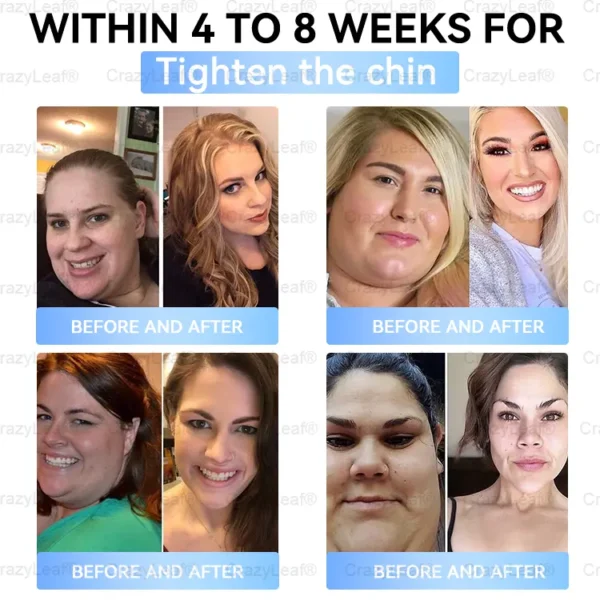 𝐵uil𝗱𝐿ea𝐟® 𝑺𝑀𝗚T-𝑮𝐋𝑃-1 𝐒limming & 𝐻ealth 𝑁ano 𝑀icroneedle 𝑃atch with Collagen & Matrixyl 3000 丨Obesity,Cardiovascular Diseas, Diabetes, Sleep Apnea, Joint Problems and More