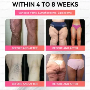 US 🏥FDA Store | 𝐵uil𝗱𝐿ea𝐟® 𝐆𝐋𝐏-𝟏 Support 𝑁ano 𝑀icroneedle 𝑃atch with Collagen & Matrixyl 3000 丨Obesity,Cardiovascular Diseas, Diabetes, Sleep Apnea, Joint Problems and More (Pink)