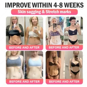 US 🏥FDA Store | 𝐵uil𝗱𝐿ea𝐟® 𝐆𝐋𝐏-𝟏 Support 𝑁ano 𝑀icroneedle 𝑃atch with Collagen & Matrixyl 3000 丨Obesity,Cardiovascular Diseas, Diabetes, Sleep Apnea, Joint Problems and More (Pink)