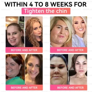 US 🏥FDA Store | 𝐵uil𝗱𝐿ea𝐟® 𝐆𝐋𝐏-𝟏 Support 𝑁ano 𝑀icroneedle 𝑃atch with Collagen & Matrixyl 3000 丨Obesity,Cardiovascular Diseas, Diabetes, Sleep Apnea, Joint Problems and More (Pink)