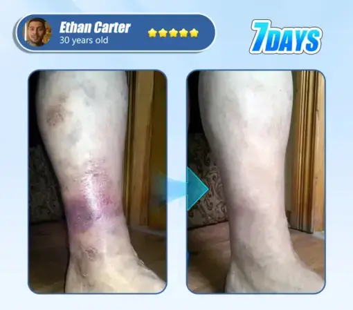 ADFIRE® Diabetic Skin Revolution