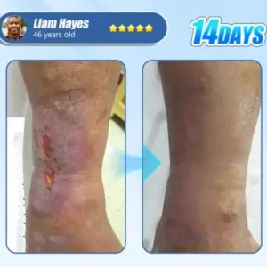 ADFIRE® Diabetic Skin Revolution