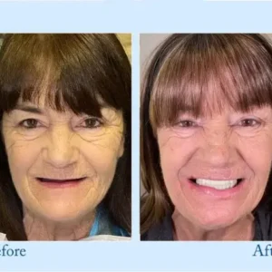 NESLEMY™ Custom-Fit Functional Dentures – Perfectly Fitted in Minutes at Home